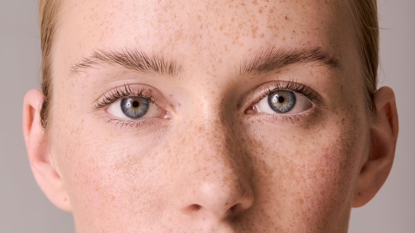 pigmentflecken1