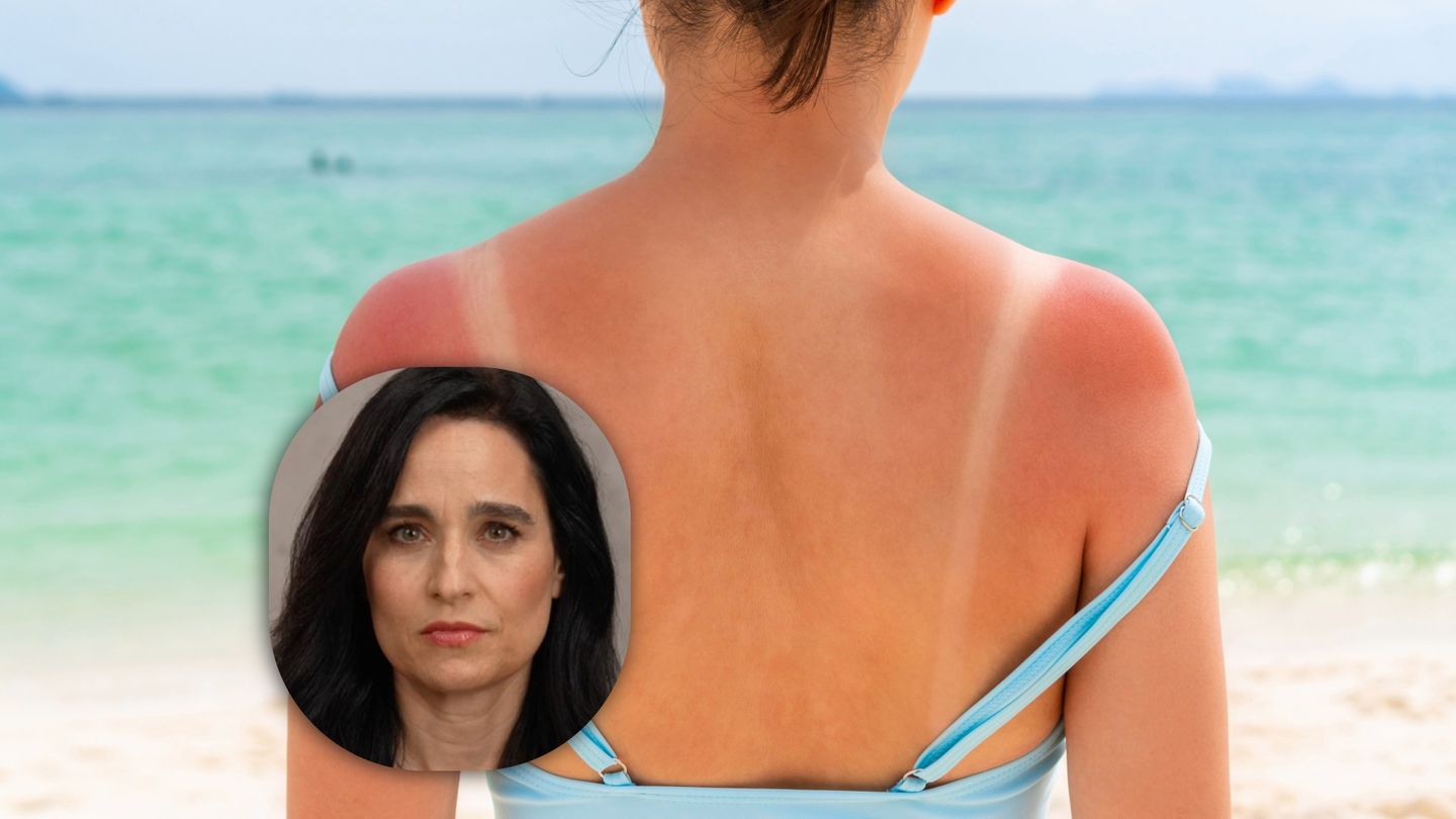 Unterschätztes Hautkrebs-Risiko: Dr. Yael Adler: "Viele wiegen sich durch Sonnencreme in falscher Sicherheit"